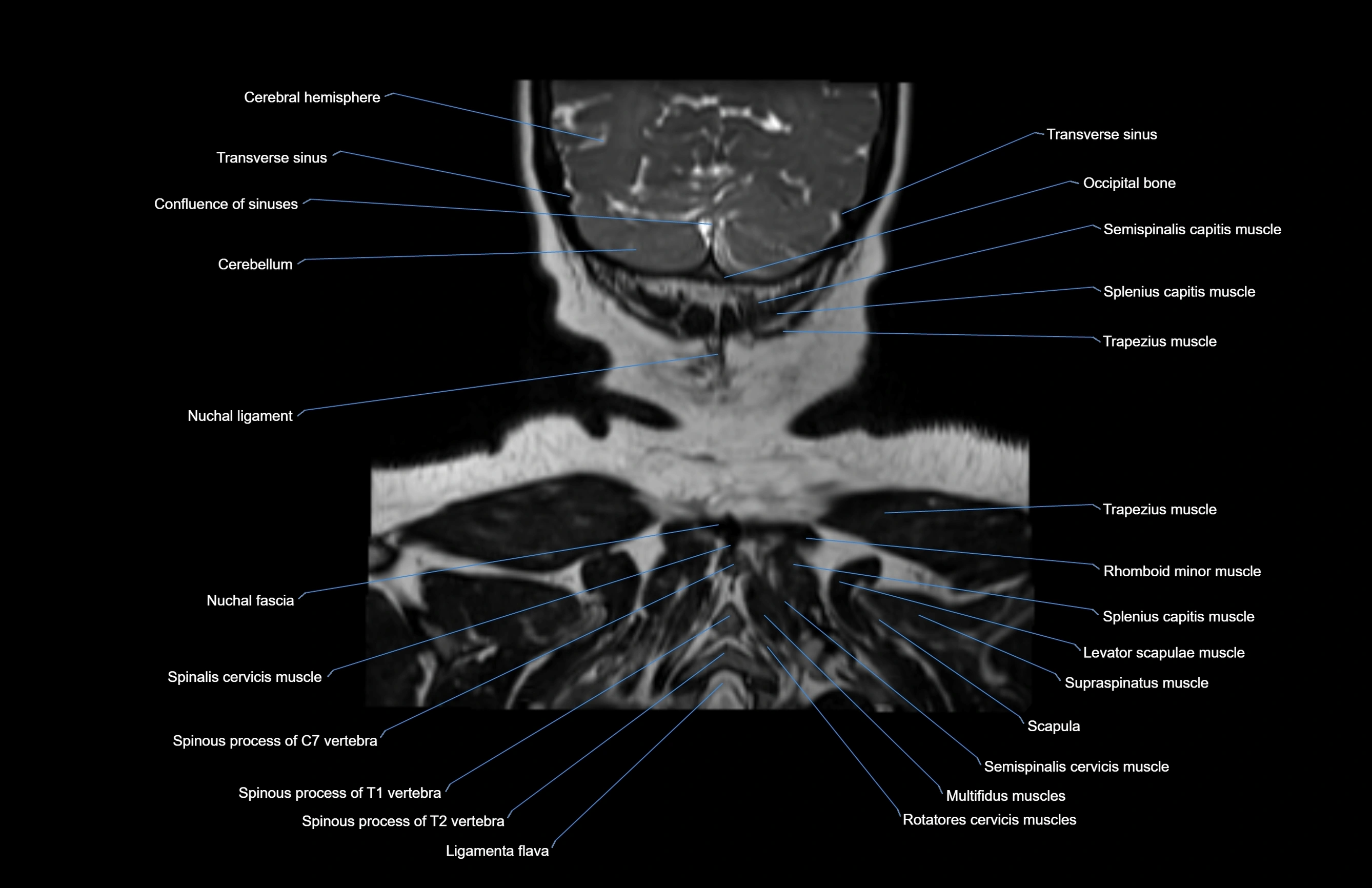 Neck coronal cross sectional MRI anatomy 3T MRI  image-img-00001-00004.webp